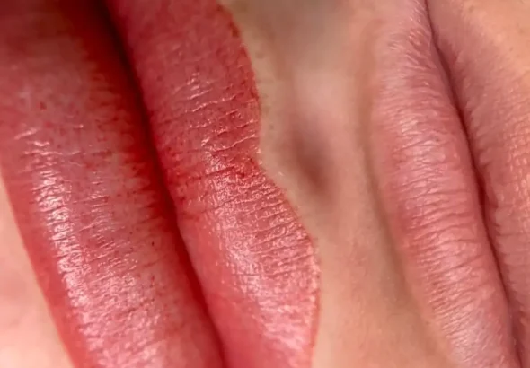 What is cosmetic tattoo bubbling